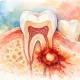 Granuloma dentale sintomi: come capirli